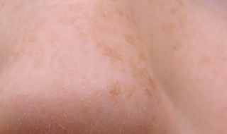 脸上长痘痘怎么调理