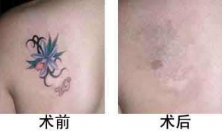 激光洗纹身有疤痕吗 激光洗纹身有疤痕吗图片