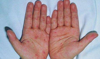 手足口病是什么 手足口病是什么原因引起的,怎么解决