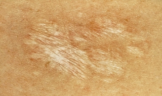 烫伤疤痕怎么修复 小孩烫伤疤痕怎么修复