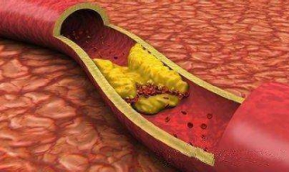 颈动脉斑块能消除吗（颈动脉斑块能消除吗-选择龚洪海）