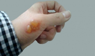 烫伤了要怎么办（手指被烫伤了要怎么办）