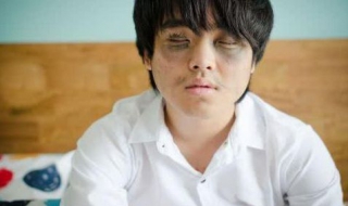 有黑眼圈怎么办 长期有黑眼圈怎么办