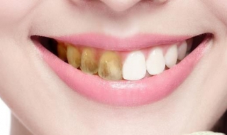 牙齿黄怎么办（牙齿黄了怎么变白最简单的方法）