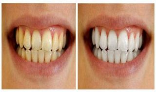 抽烟牙齿黄怎么办 抽烟牙齿很黄怎么办