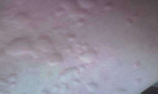 得了寻麻疹全身水肿怎么办（寻麻疹引起的水肿多久才能消除）