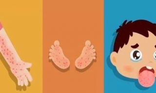 手足口病图片 手足口病图片与症状图片大全