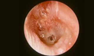 中耳炎怎么治疗 中耳炎怎么治疗才能彻底根除