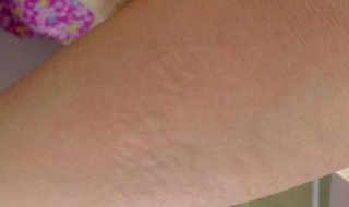 如何鉴别麻疹（如何鉴别麻疹,风疹,幼儿急疹）