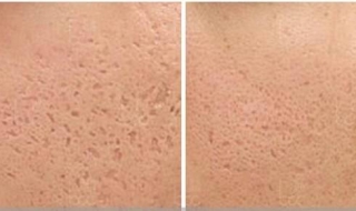 毛孔的收缩毛孔方法 毛孔的收缩毛孔方法有哪些