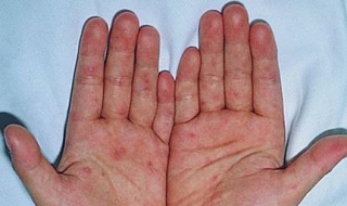 手足口病图片（手足口病图片初期图片）