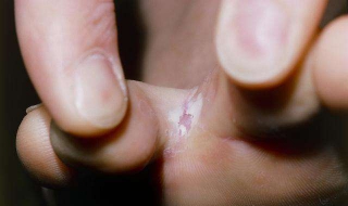 该如何治脚气（如何治脚气脚臭止痒）