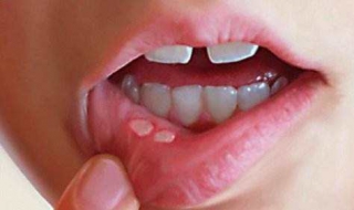 上火口腔溃疡怎么办 小孩上火口腔溃疡怎么办