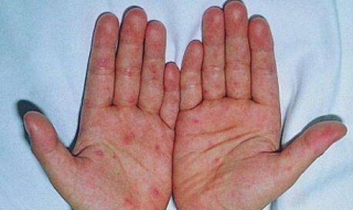 手足口病图片 手足口病图片卡通