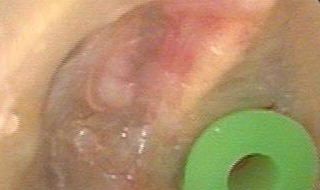 中耳炎怎么治疗（中耳炎怎么治疗用什么滴耳液）