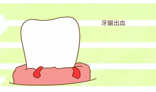 牙龈出血是什么原因 牙龈出血是什么原因吃什么药