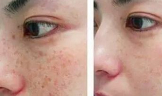祛斑好方法（祛斑好方法不反弹）