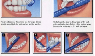 牙结石怎么去除 牙结石怎么去除简单的方法