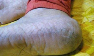 脚底脱皮怎么办 儿童脚底脱皮怎么办