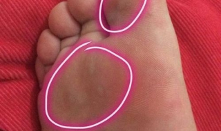 脚裂口子怎么办（冬天手脚裂口子怎么办）