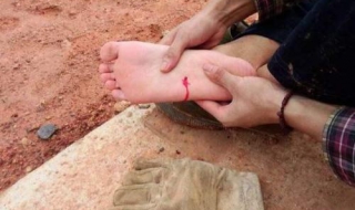 脚被钉子扎了怎么办 脚被钉子扎了怎么办吃什么消炎药