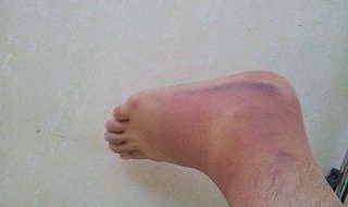 脚被开水烫了怎么办 脚被开水烫了怎么办用冷水多少时间