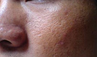 男生脸部毛孔粗大怎么办 男生脸部毛孔粗大怎么办呢