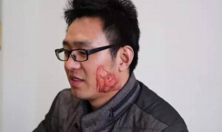 疤痕增生怎么办（剖腹产疤痕增生怎么办）