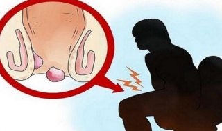 如何预防痔疮，介绍以下方法 痔疮如何防止和预防