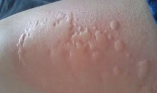 腿部皮肤过敏怎么办（腿部皮肤过敏怎么办用什么药）