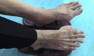 脚指甲往肉里长怎么办（指甲长肉里化脓了怎么解决）