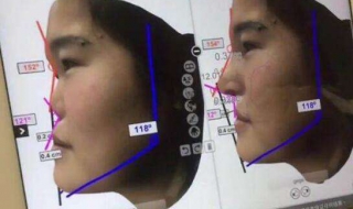 鼻子扁怎么办 鼻子扁怎么办简单小方法