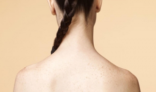 后背长痘痘怎么办 胸口和后背长痘痘怎么办