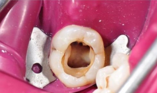 蛀牙牙疼怎么办（蛀牙疼怎么办）