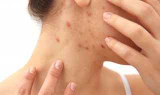 长了青春痘怎么办 长了青春痘怎么办用什么药膏