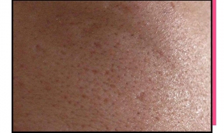 鼻子毛孔粗大怎么办 化妆鼻子毛孔粗大怎么办