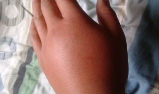 马蜂蛰了怎么办（被一只马蜂蛰了怎么办）