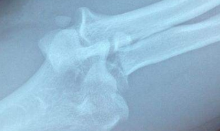 骨裂怎么办 肋骨骨裂怎么办