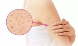 鸡皮皮肤怎么办（鸡皮皮肤怎么办?）