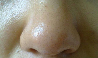 鼻头肥大怎么办（12岁女孩鼻头肥大怎么办）