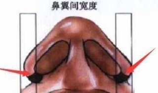 鼻翼太大怎么办 鼻翼太大怎么办?