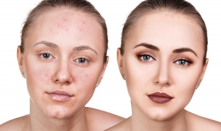 脸上长痘印怎么办（脸上痘印太多怎么办）