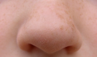 鼻翼两侧长痘怎么办 鼻翼两侧长痘怎么办小妙招