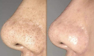 鼻子长黑头怎么办（10岁孩子鼻子长黑头怎么办）