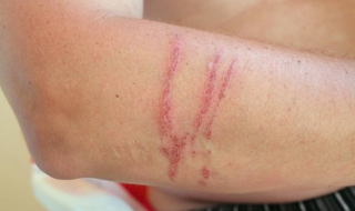 疤痕疙瘩怎么办（身体长疤痕疙瘩怎么办）