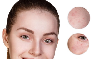 额头老长痘痘怎么办 额头长痘痘怎么办?