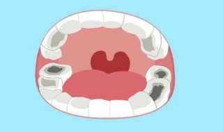 蛀牙痛怎么办（小孩长蛀牙痛怎么办）