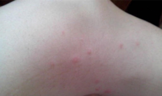 身上起红疙瘩很痒怎么办 小孩子身上起红疙瘩很痒怎么办