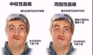 面瘫怎么办（脸部轻微面瘫怎么办）