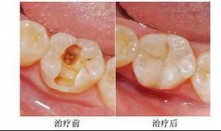 龋齿怎么办 牙齿有龋齿怎么办